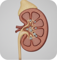 Kidney Stones